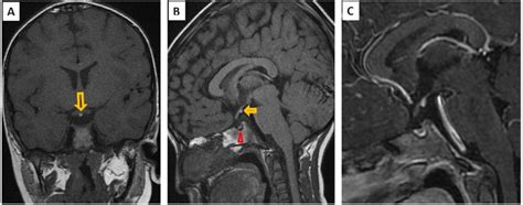 pituitary stalk interruption syndrome